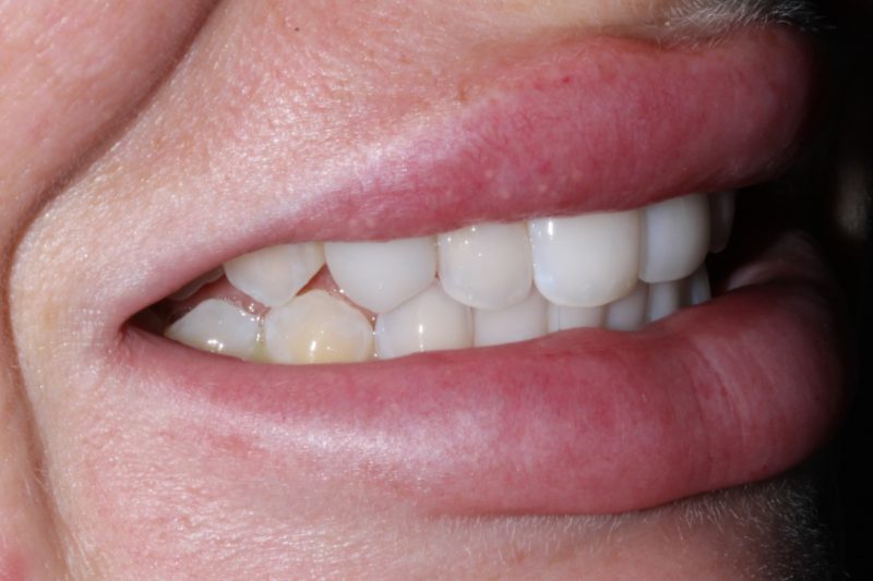 Before veneers Dr Aleem