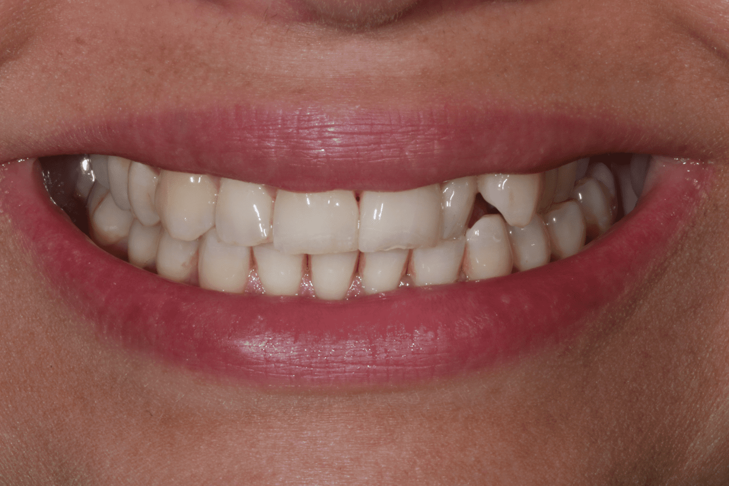Before dental veneers