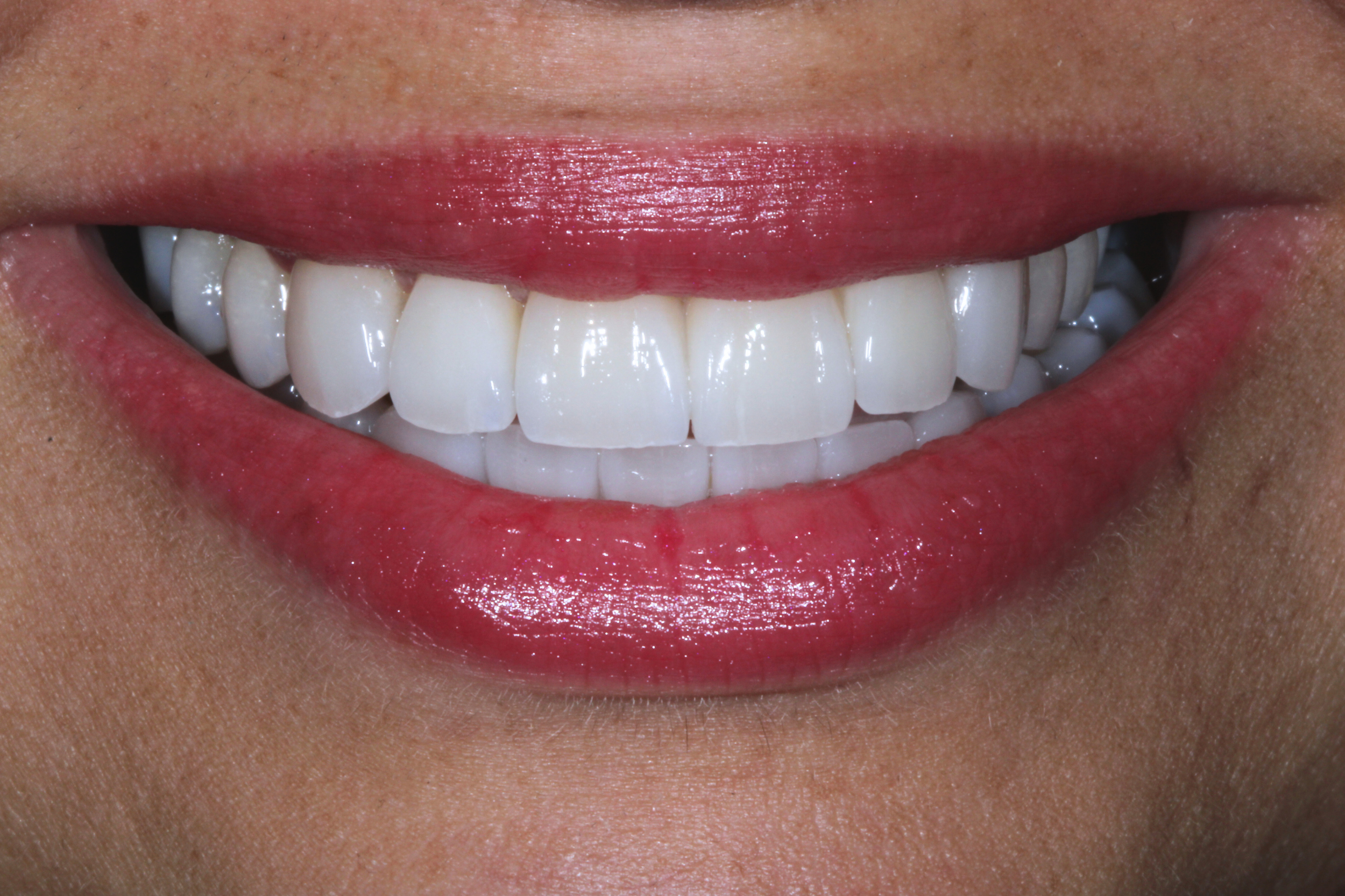 Full mouth veneers TKC Dental