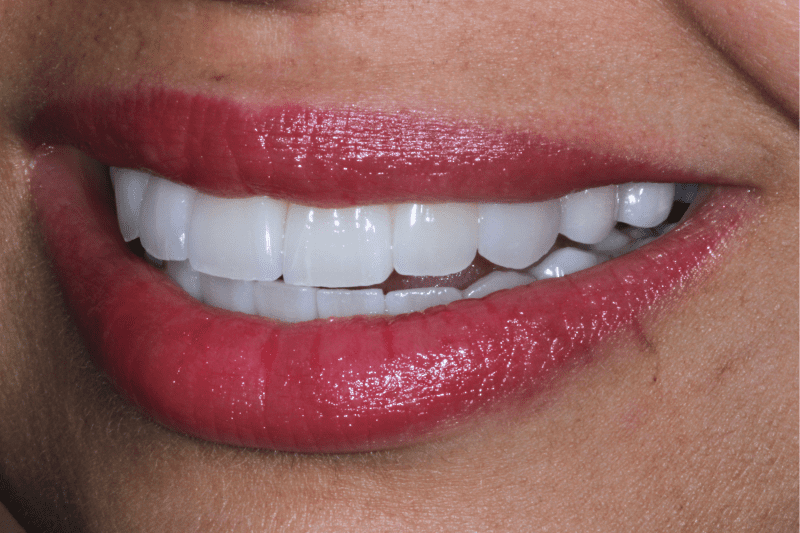 Smile design by Dr Aleem Smile design by Dr Aleem