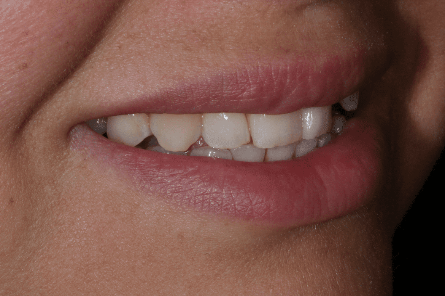 Before dental veneers