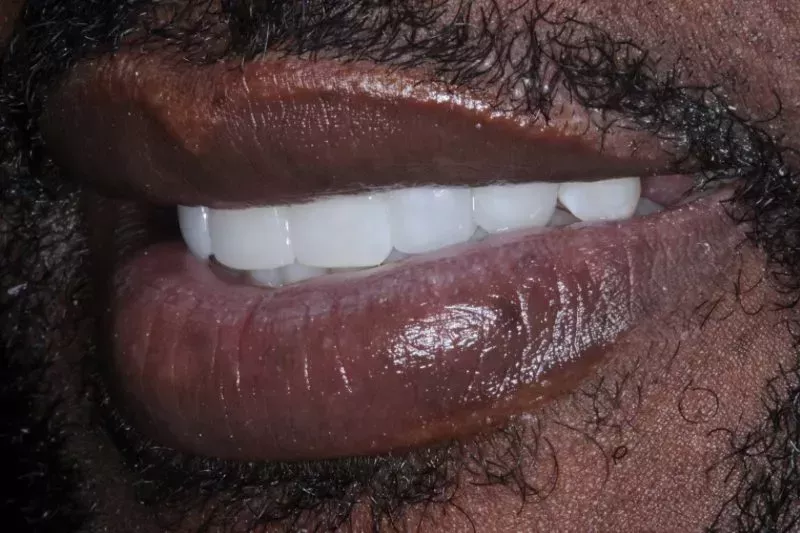 After Invisalign treatment