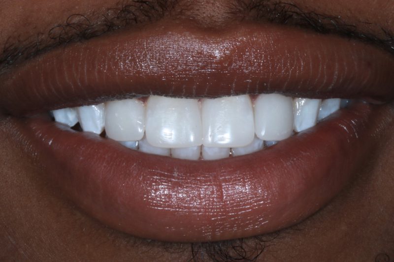 AFTER COSMETIC BONDING BY DR ALEEM