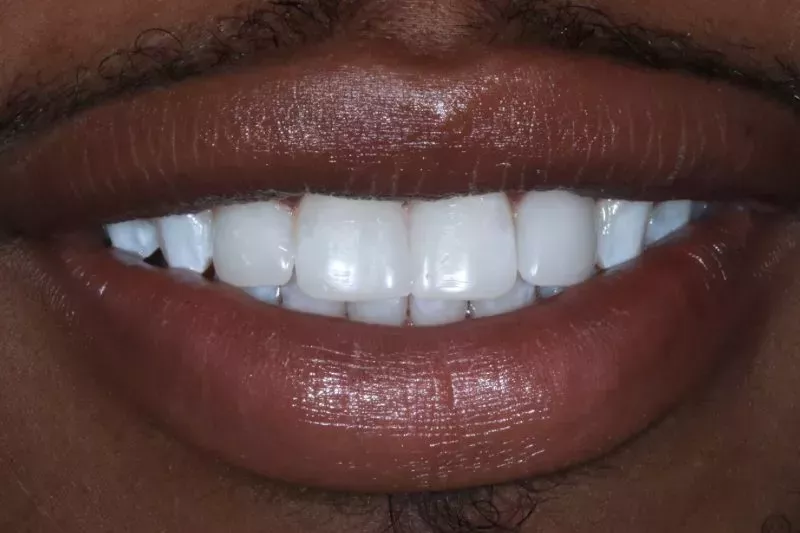 AFTER COSMETIC BONDING BY DR ALEEM