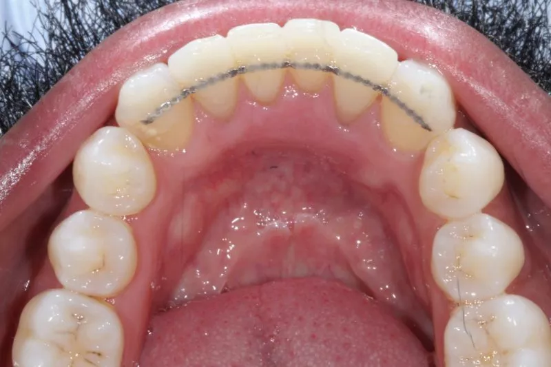 AFTER INVISALIGN BY DR ALEEM AFTER INVISALIGN BY DR ALEEM