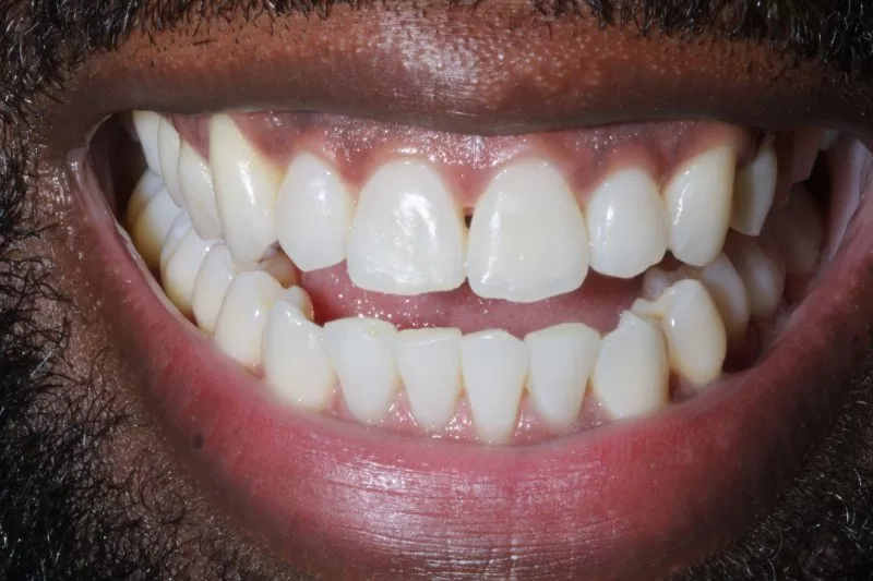 AFTER INVISALIGN AFTER INVISALIGN BY DR ALEEM