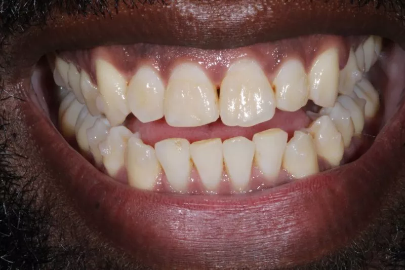 BEFORE FINAL INVISALIGN BEFORE FINAL INVISALIGN