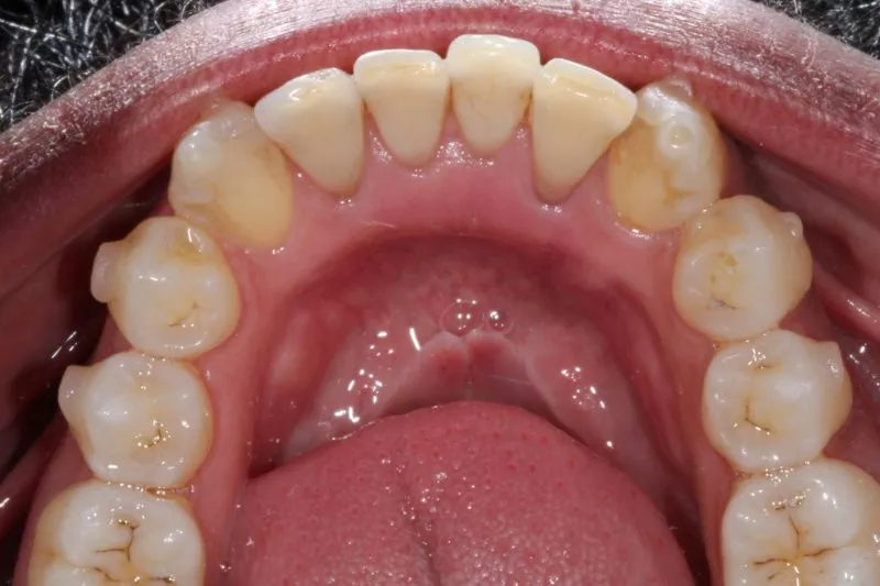 CROOKED LOWER ARCH CROOKED LOWER ARCH