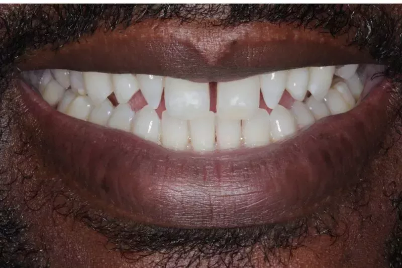 After Invisalign treatment