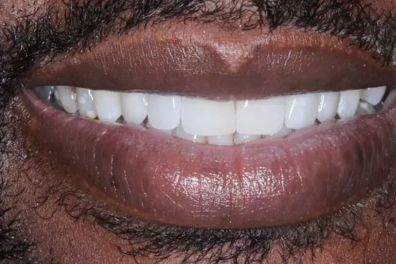 After Invisalign treatment
