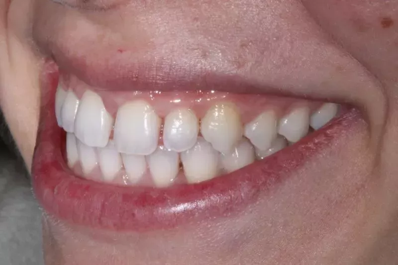 GAPPY SMILE BEFORE VENEERS