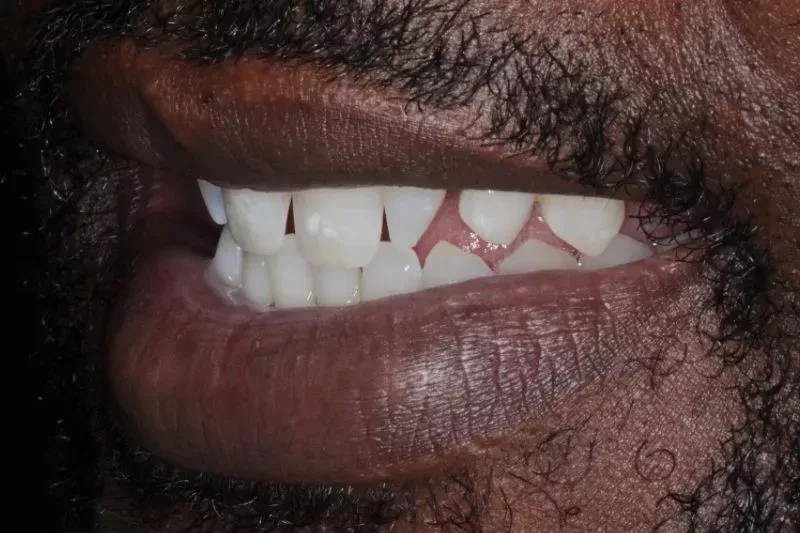 After Invisalign treatment