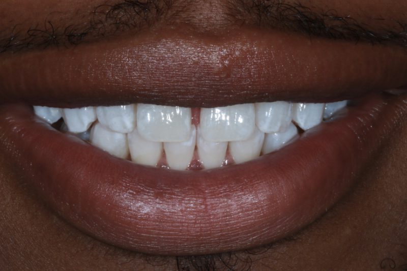 GAPS BEFORE COSMETIC BONDING