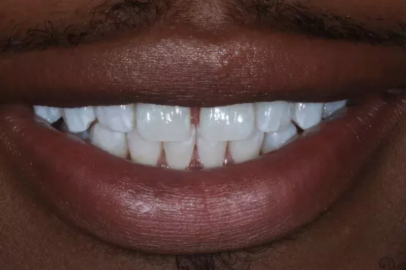 GAPS BEFORE COSMETIC BONDING