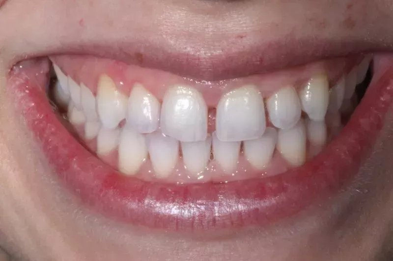 GAPS BEFORE VENEERS