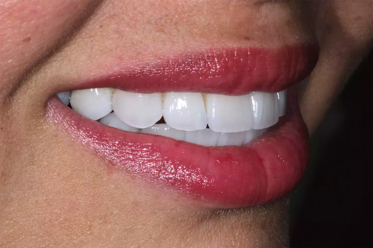 Zero damage veneers Dr Aleem