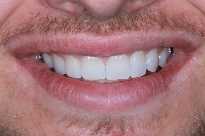 after non cutting veneers