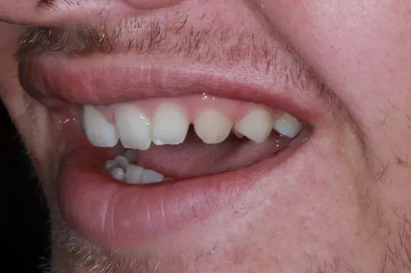 before porcelain veneers