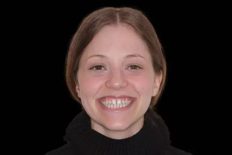 GAPS IN SMILE BEFORE VENEERS