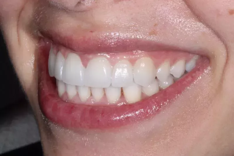 CLOSED GAPS AFTER TKC VENEERS