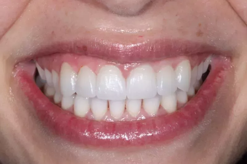 CLOSED GAPS WITH UPPRE VENEERS