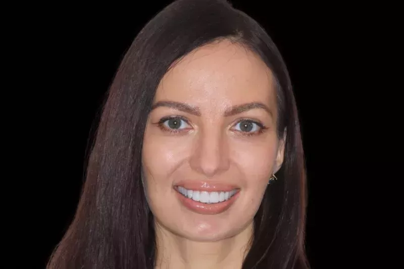 After non preparation veneers by Dr Aleem