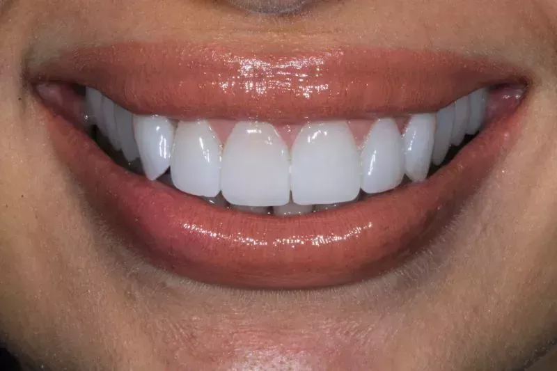 full mouth non preparation veneers