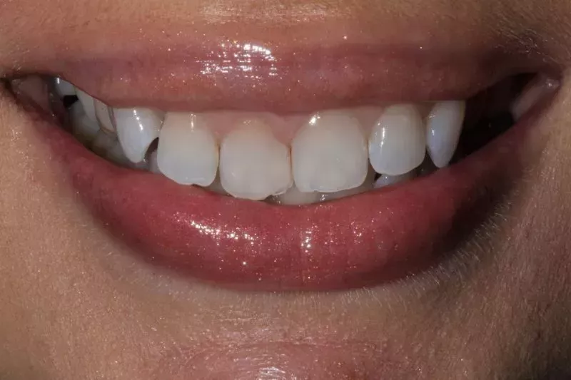 before veneers misaligned teeth