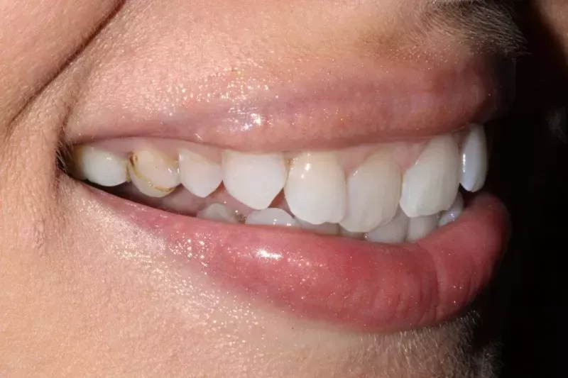 before veneers misaligned teeth