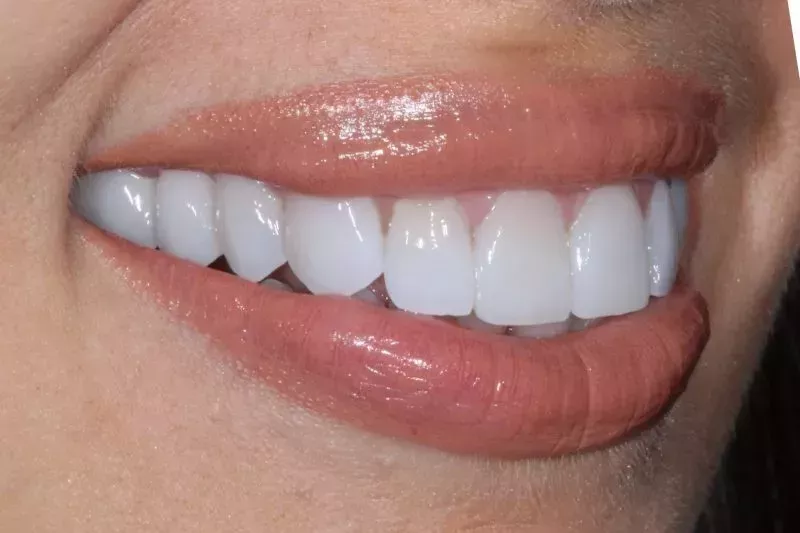 after non preparation veneers by dr aleem