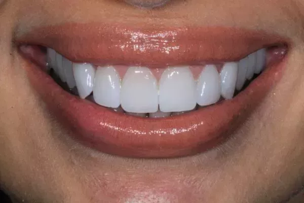 after-no-prep-veneers-2 no prep veneers london