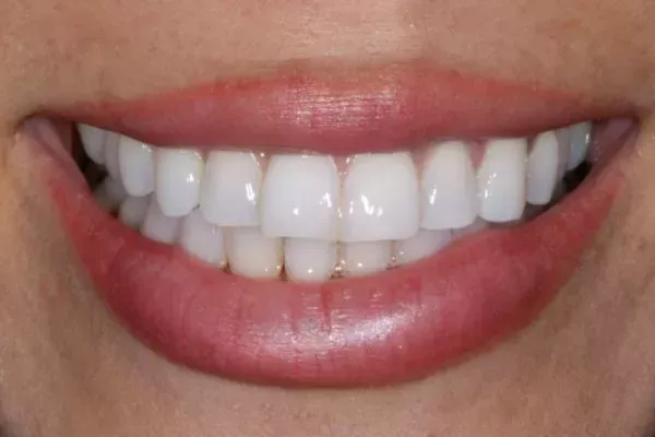 what is invisalign braces – 1 what is invisalign braces example