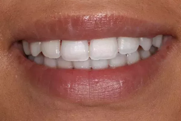 what is invisalign braces – 2