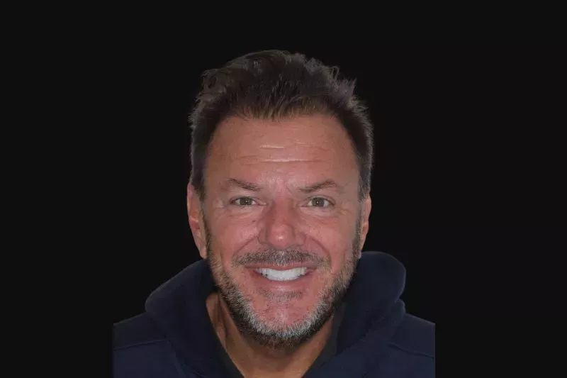 AFTER NO PREPARATION VENEERS