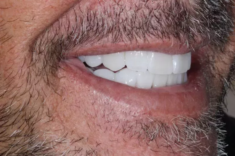 AFTER PORCELAIN VENEERS