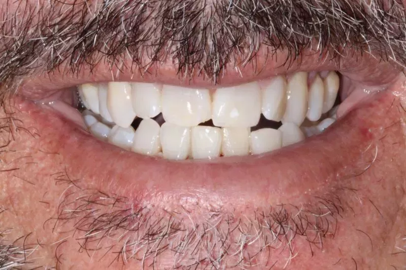 BEFORE NO PREP VENEERS