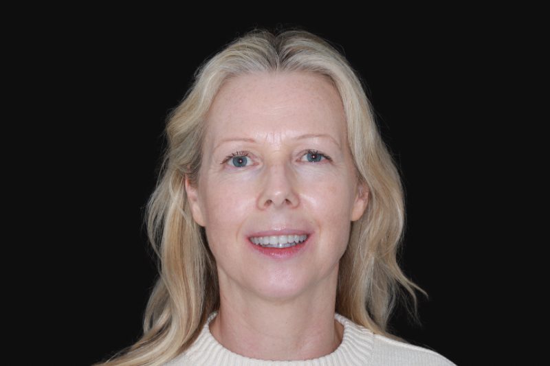 straight teeth with invisalign