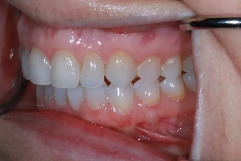STRAIGHTER TEETH INVISALIGN