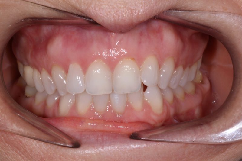 CROOKED TEETH BEFORE INVISALIGN