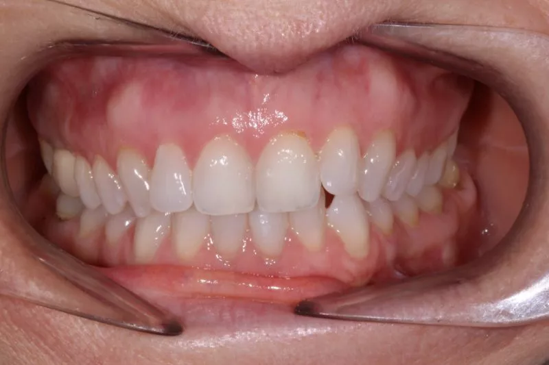 CROOKED TEETH BEFORE INVISALIGN