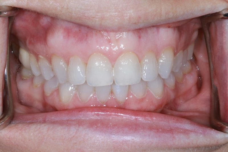 STRAIGHTER TEETH INVISALIGN