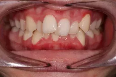 braces before after simona