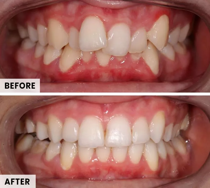 tkc-ad-before-after-align