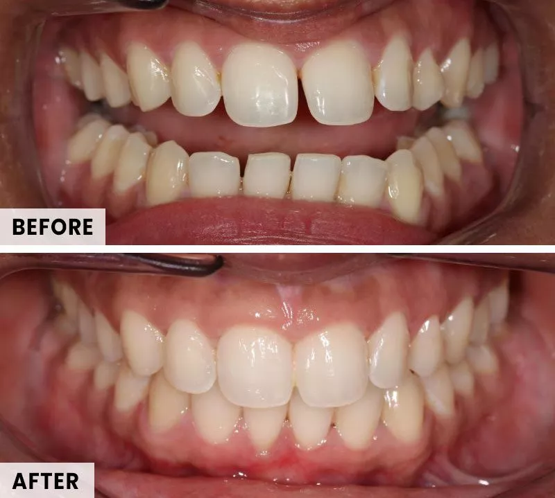 tkc-ad-before-after-gap-2
