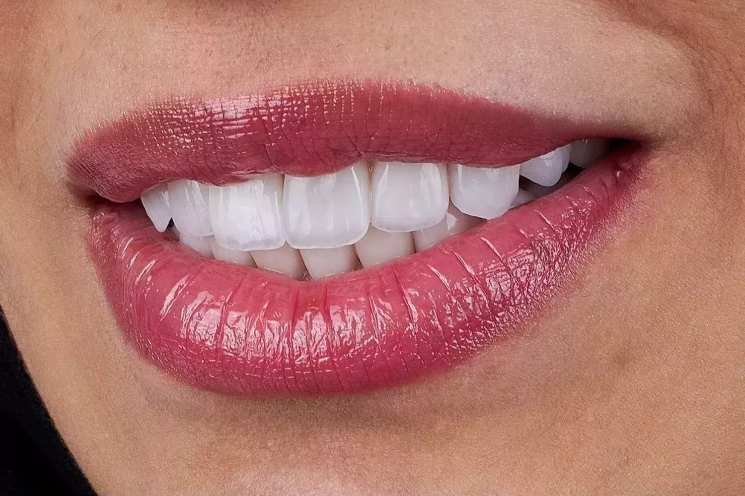 dental-veneers-smile