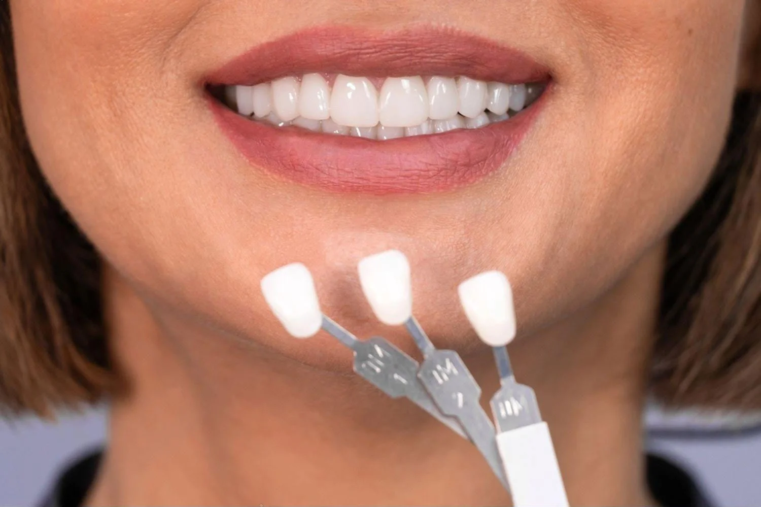 veneers-cost-uk veneers cost uk