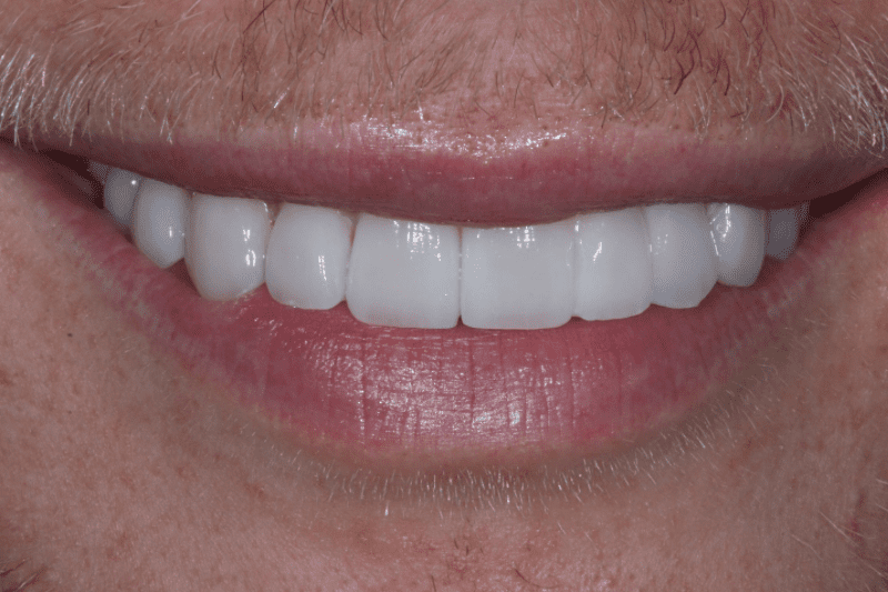 AFTER TKC DENTAL VENEERS AFTER-TKC-DENTAL-VENEERS