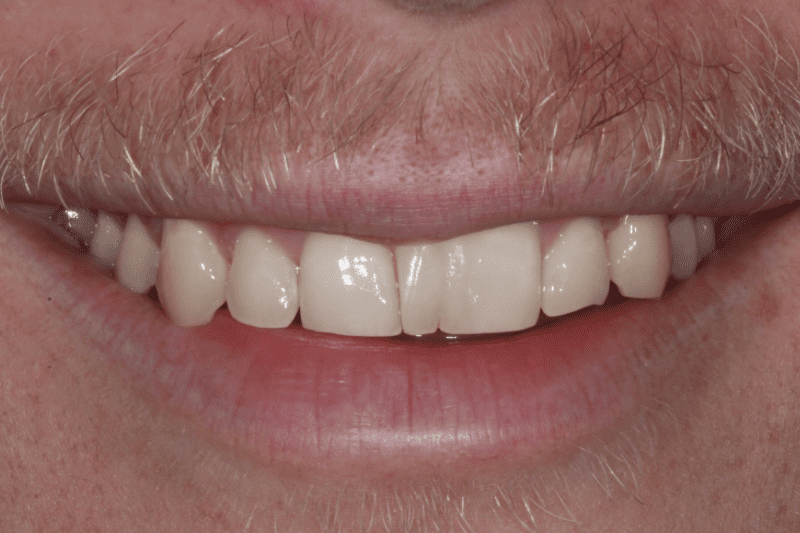 NATURAL TEETH BEFORE NO PREP VENEERS NATURAL-TEETH-BEFORE-NO-PREP-VENEERS