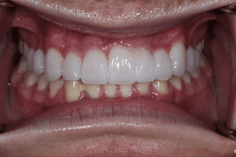 after dr aleem no prep veneers dr aleem signature no prep veneers zero damage