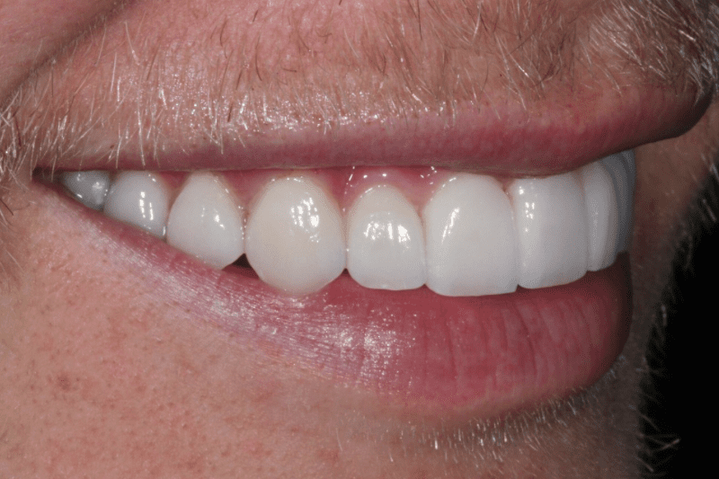 after porcelain veneers TKC DENTAL- 2 after-porcelain-veneers-TKC-DENTAL